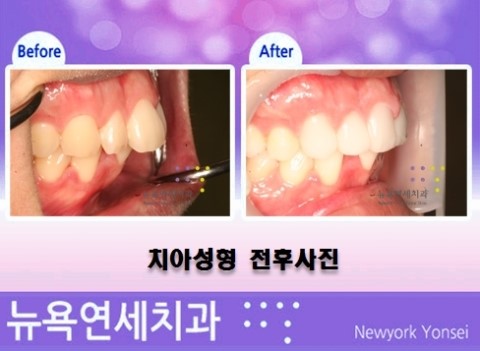  돌출입치아성형비용,돌출입치아성형,돌출입교정비용,돌출입교정치과