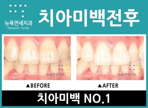  원데이치아미백비용,원데이치아미백,원데이치아미백방법,원데이치아미백추천