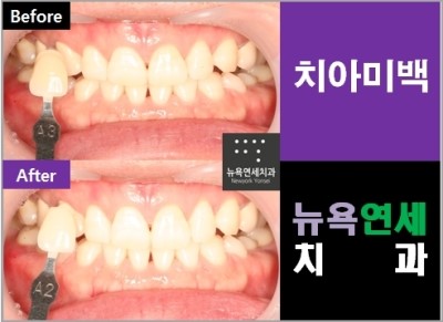  원데이치아미백치과,원데이치아미백,원데이치아미백추천,원데이미백