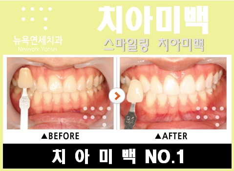  치아미백치과비용,치아미백치과,치아미백치과추천,치아미백비용