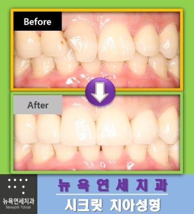 앞니 치아성형비용,치아성형,치아성형잘하는곳,라미네이트치아성형