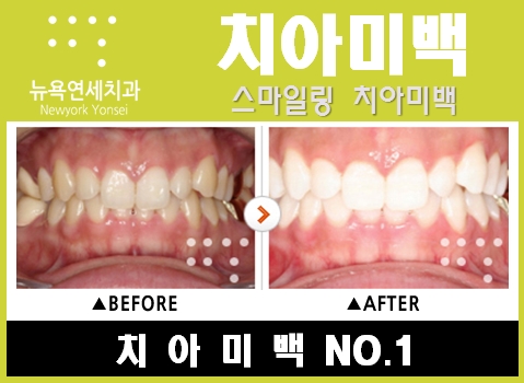  치아미백비용싼곳,치아미백비용,치아미백비용상담,치아미백잘하는곳