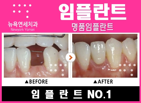  임플란트치과병원,임플란트치과,임플란트치과병원추천,임플란트치과비용