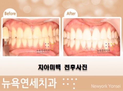  치아미백이벤트비용,치아미백이벤트,치아미백비용,치아미백비용추천