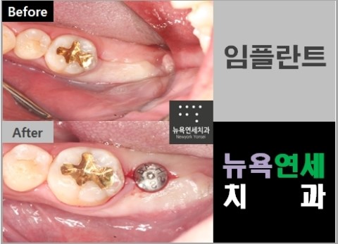 임플란트수술비용,임플란트수술,임플란트수술방법,임플란트치과수술