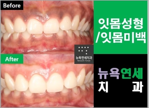  잇몸성형비용,잇몸성형,잇몸성형잘하는치과,거미스마일잇몸성형