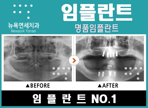  틀니임플란트방법,틀니임플란트,임플란트틀니비용,임플란트틀니