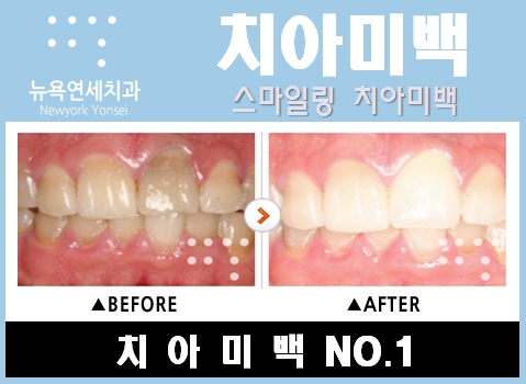  치아미백 케이스별 사례 _ 선천적황니, 약물변색된 치아를 전문가미백