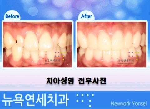  [라미네이트 앞니성형] 벌어진 앞니, 불규칙한 앞니를 치아성형하는 방법