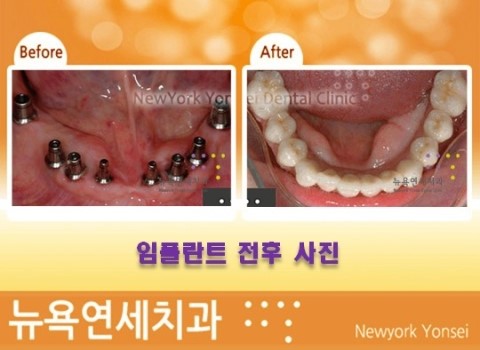  @@@ 임플란트수술과정,임플란트수술,임플란트수술방법,임플란트수술후 @@@