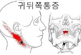 귀뒤쪽통증 : 네이버 블로그