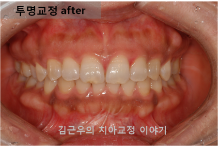 대전치과유명한곳 벌어진 치아는