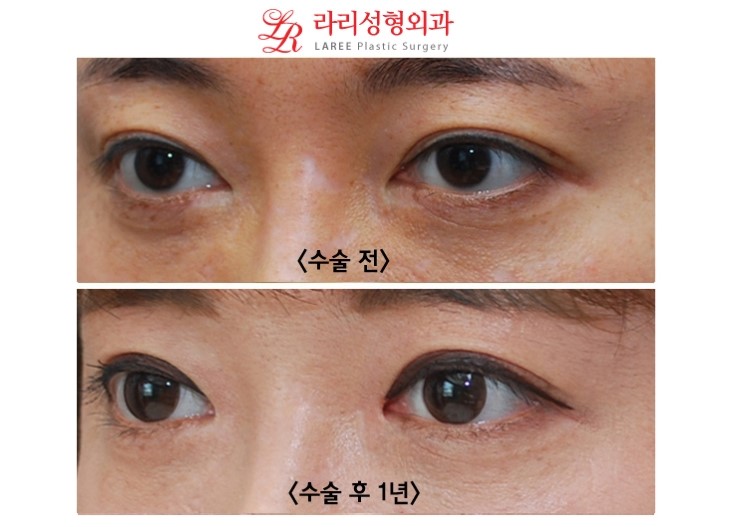 앞트임 복원 수술(앞트임 재건) 5