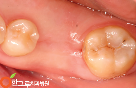 최소한의 치은 절개, 임플란트에 문제 없음 2