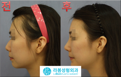라봄성형외과] 강남메부리코성형 전문 ♧ : 네이버 블로그