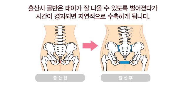 출산후 골반통증 왜 생길까? 7