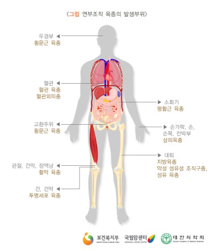 피부의 조직구 육종