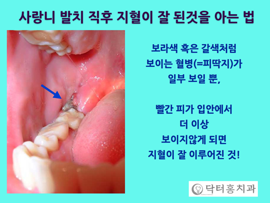 사랑니 발치 후에도 출혈이 멈추지 않는 4가지 이유 11