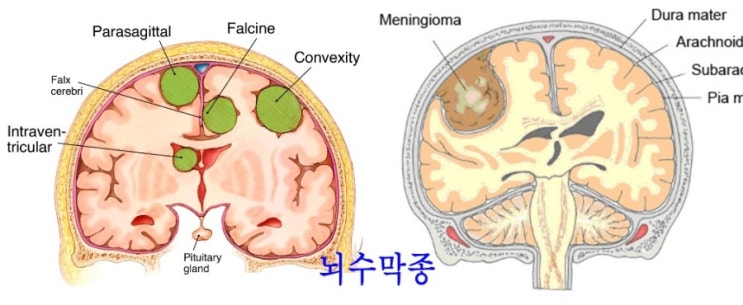뇌종양종류수막종,하수체선종,수막종이란