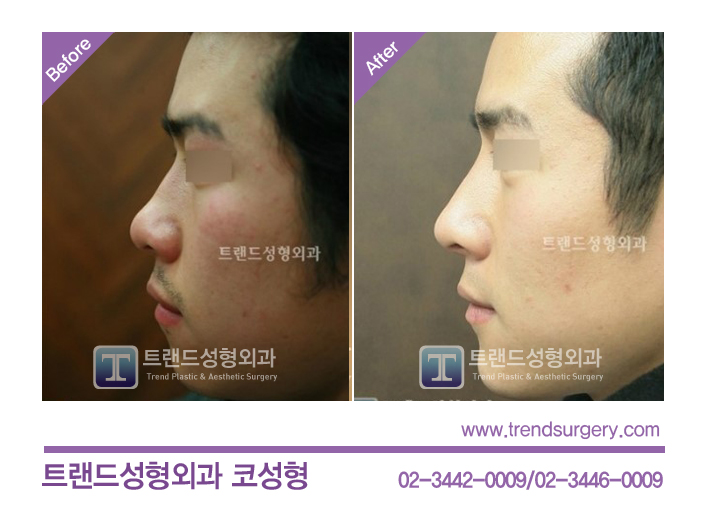코성형 남자코 수술사례 : 네이버 블로그 코성형 남자코 수술사례 : 네이버 블로그