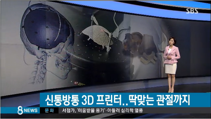 2015.03.14 SBS 8시 뉴스 3D 관절도 프린트하는 3D프린터 이용 사례