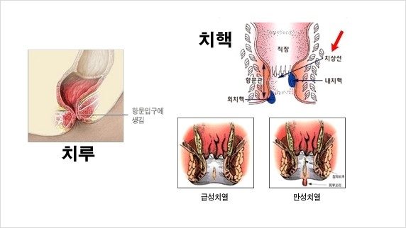 피똥싸는이유 5가지 치질이 아닐수도 있어요 7