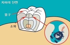 어린이 충치예방 치아홈메우기(치면열구전색)란?