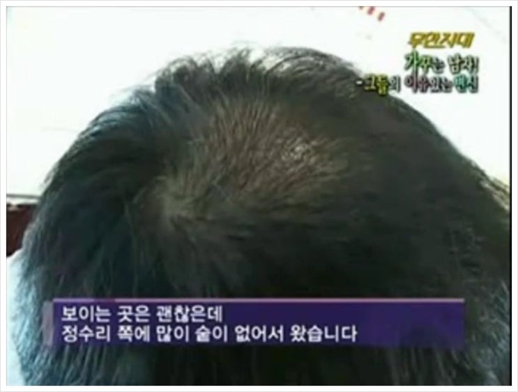  세븐레마의원'KBS2 무한지대 탈모!가꾸는 남자'