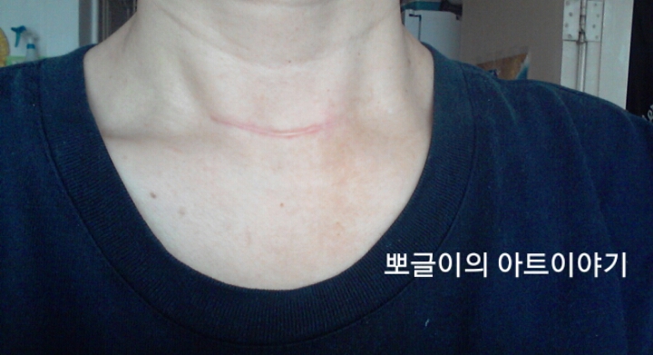  갑상선수술후 피부과 흉터클리닉 6번째 병원갔다왔어요.