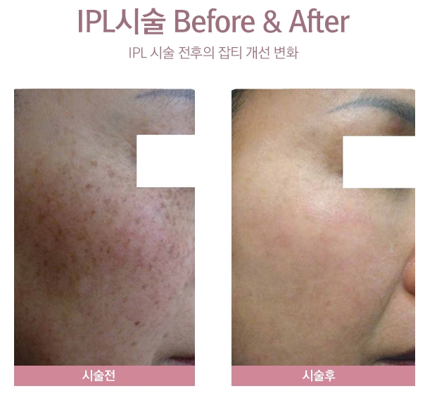  IPL 효과 확실한곳