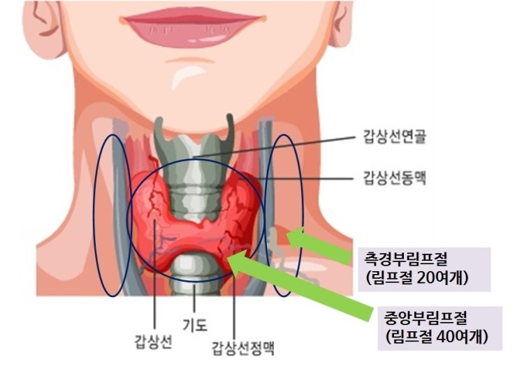 갑상선암 수술 후기 | 갑상선 유두암 | 반절제 | 경부 림프절 전이