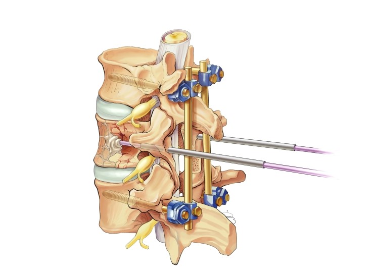  메디컬일러스트ㅣVertebroplasty-augmented short-segment posterior fixation