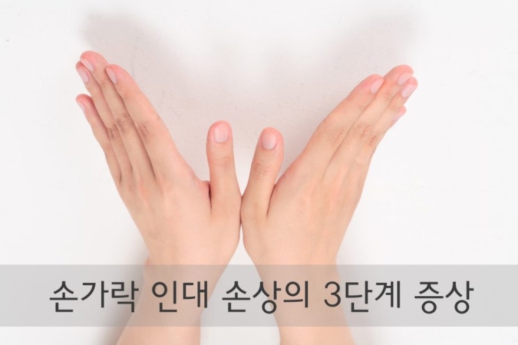손가락인대파열이 일어났다면 늦기 전에