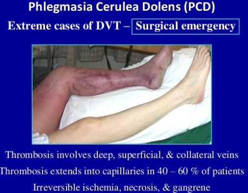Deep Vein Thrombosis 심부정맥혈전증 네이버 블로그 Deep Vein Thrombosis 심부정맥혈전증 네이버 블로그
