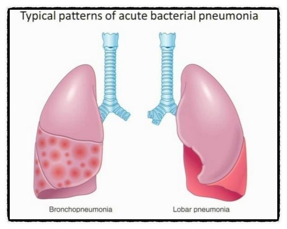 폐렴의 분류(Classification Of Pneumonia )