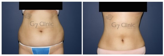 수원 인계동 복부지방흡입 4주차효과 2