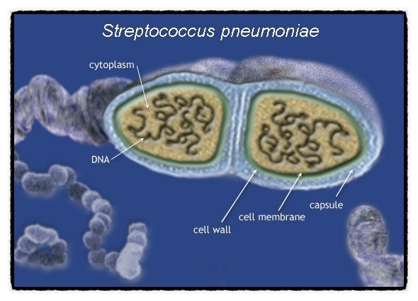 정형성 폐렴(typical pneumonia) vs 비정형 폐렴(atypical pneumonia) = 걸어다니는 폐렴, 보행폐렴(walking pneumonia)