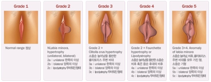 거뭇거뭇한 소음순, 성경험 많은 여자로 오해.. 레이저소음순수술로 핑크빛으로 변신!! : 네이버 블로그 거뭇거뭇한 소음순, 성경험 많은 여자로 오해.. 레이저소음순수술로 핑크빛으로 변신!! : 네이버 블로그