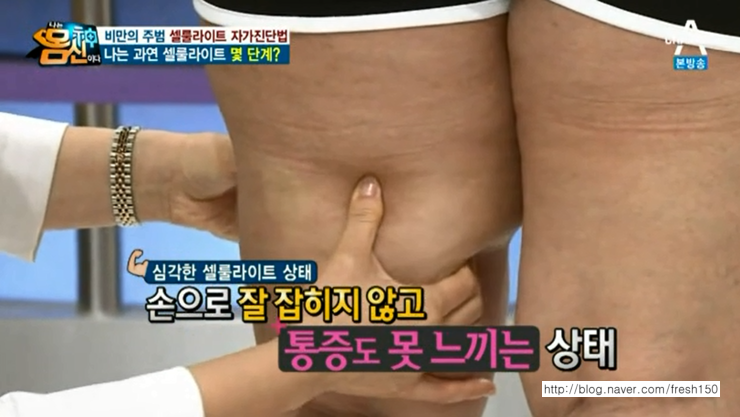 허벅지 셀룰라이트 없애는 방법!