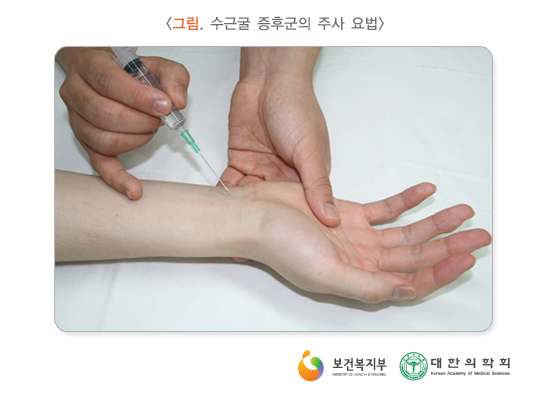 손목터널증후군 증상이 낫지 않을 경우 비수술치료병원