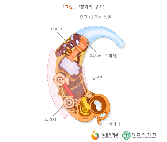 어쩔 수 없는 보청기 타입 선택 기준! 알려드립니다. — 원문 이미지 4