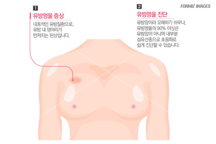 유방의 섬유선종을 나타낼 수 있는 증상 5