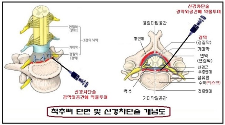 요추 및 기타 추간판 장애로 경피적 경막외 신경성형술 치료 시 질병 수술비를 보상받을 수 있습니까? – 네이버 지식인 Q&A