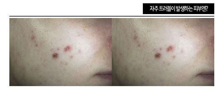 좁쌀여드름 원인 면역력 저하 환절기