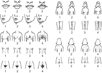 다낭성 난소 증후군의 증상 - 다모증, 털이 많은 경우 : 네이버 블로그