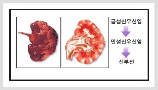 급성 방광염, 신우신염의 원인, 증상과 치료 4