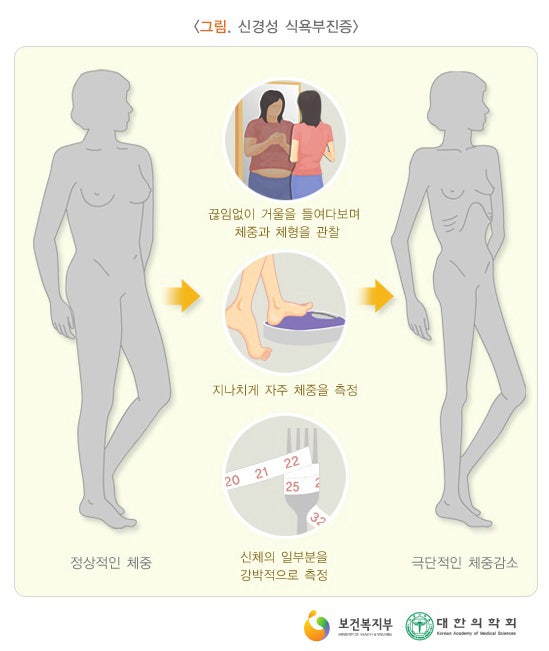 거식증 초기증상과 자가진단법