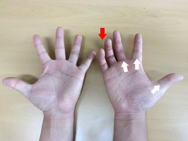 팔꿈치터널증후군 손가락 힘빠짐 원인 팔꿈치터널증후군 손가락 힘빠짐 원인