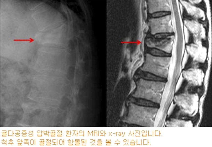 인천골다공증 척추압박골절 비수술치료