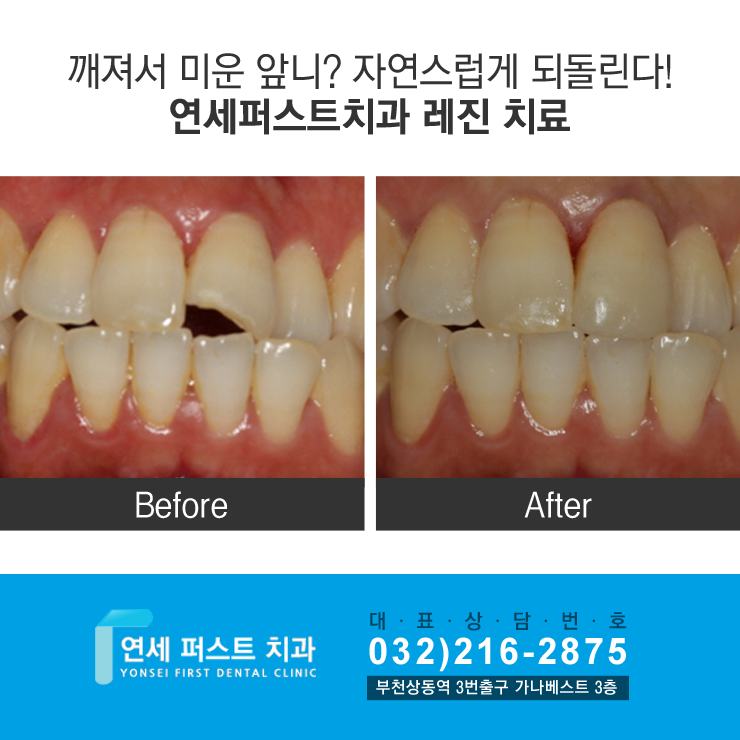 부천 상동 중동에서 발생한 앞니레진 치료